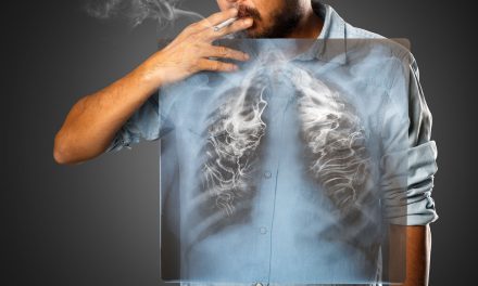 Karcinom pluća – uzrok, simptomi, liječenje