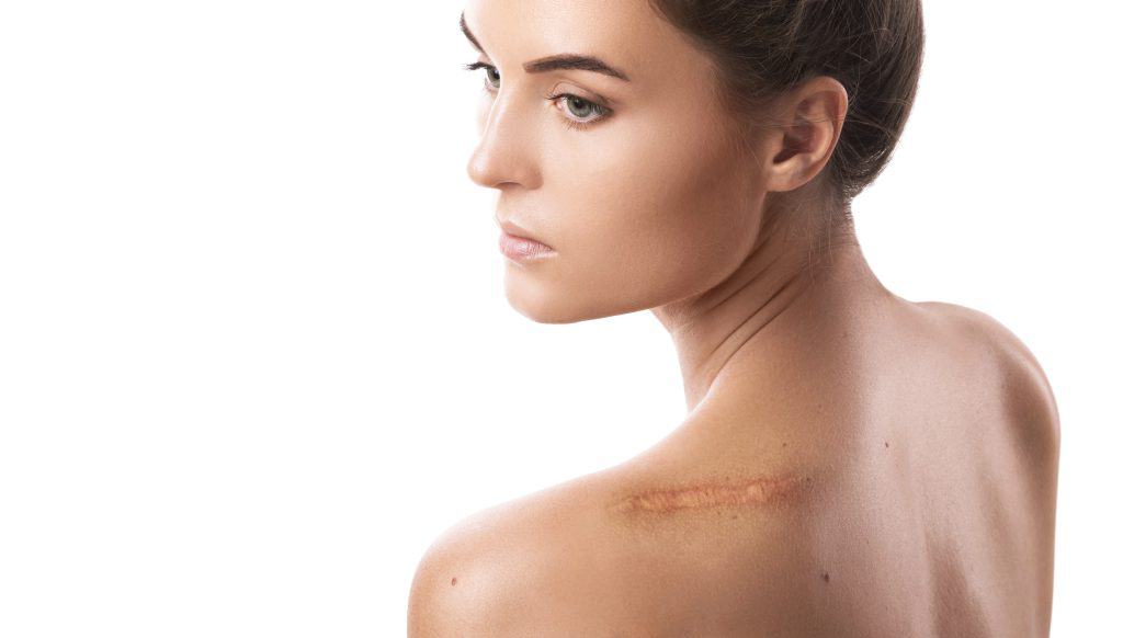 Optimalno cijeljenje rane radi prevencije nastanka ožiljka