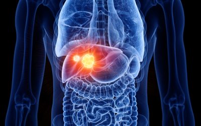 Rak jetre – uzrok, simptomi, liječenje
