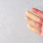 Raynaudova bolest – uzrok, simptomi, liječenje