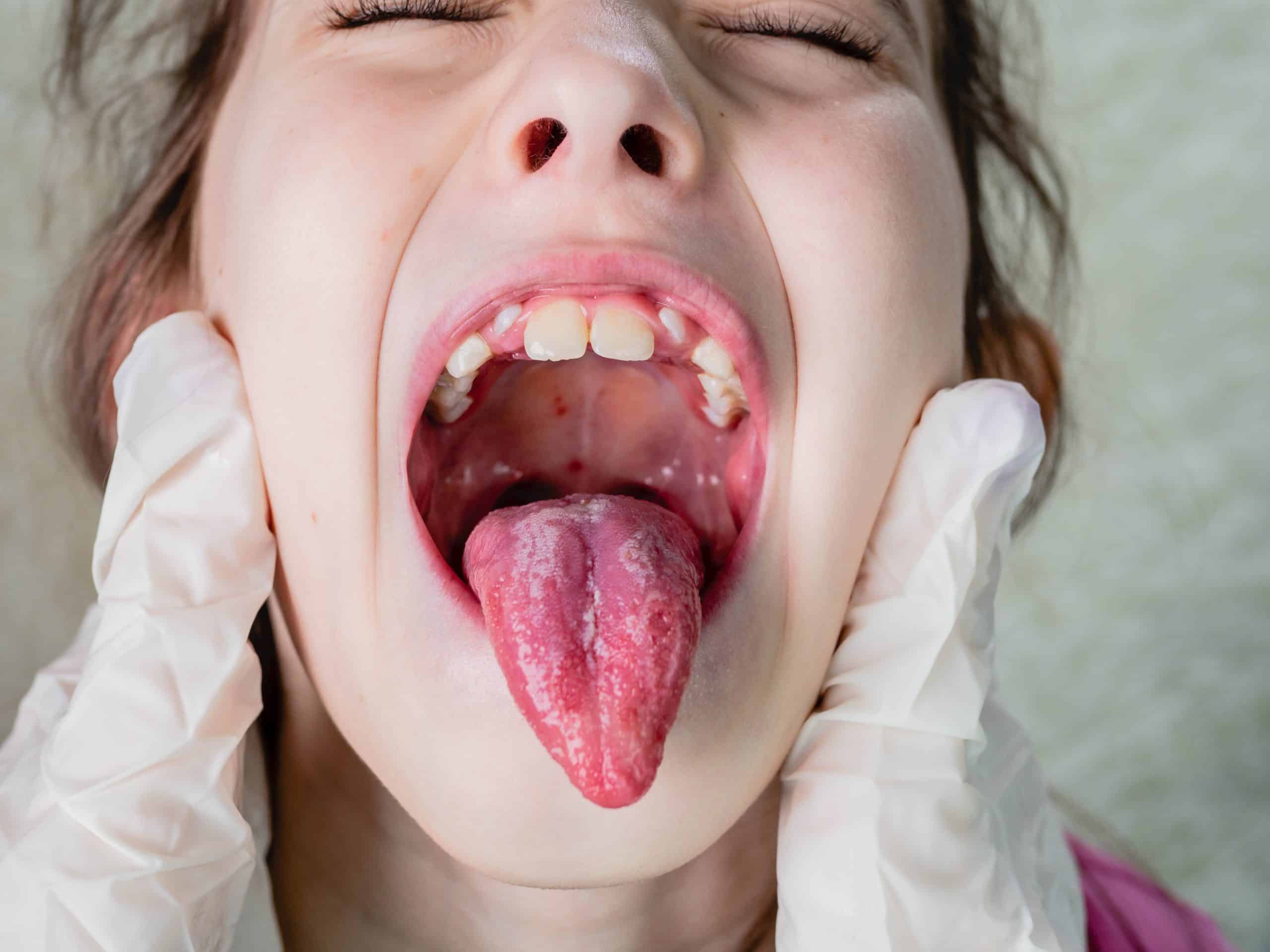 Tonzilitis - uzrok, simptomi, liječenje - Arz.hr