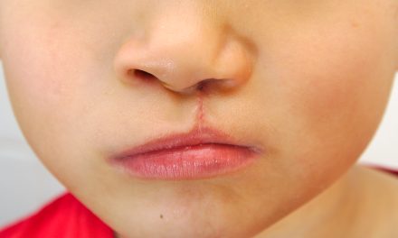 Uzroci nastanka rascjepa usne i nepca