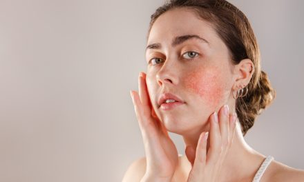 Crvenilo kože – uzrok, simptomi, liječenje