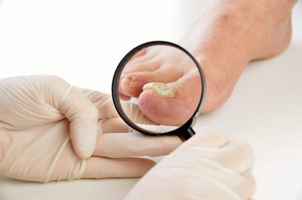 Gljivična infekcija noktiju - uzrok, simptomi, liječenje