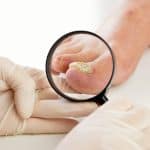 Gljivična infekcija noktiju – uzrok, simptomi, liječenje