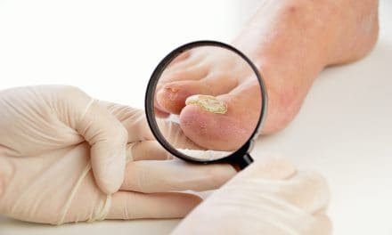 Gljivična infekcija noktiju – uzrok, simptomi, liječenje