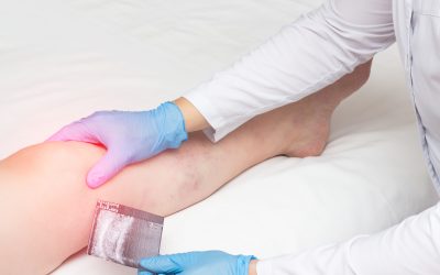 Gonarthrosis koljena – uzrok, simptomi, liječenje