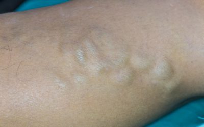Ispupčene vene na nogama – uzrok, simptomi, liječenje