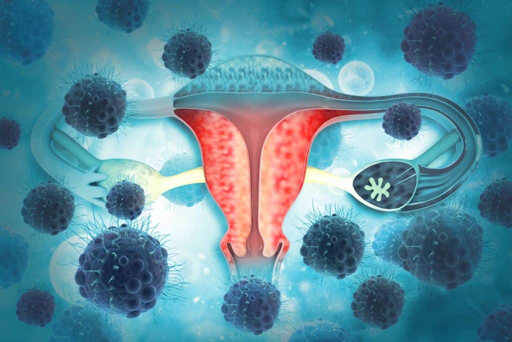 Karcinom jajnika - uzrok, simptomi, liječenje
