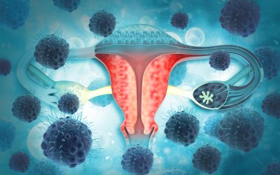 Karcinom jajnika – uzrok, simptomi, liječenje