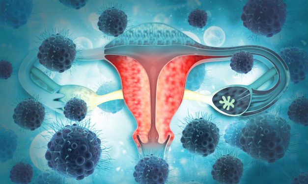 Karcinom jajnika – uzrok, simptomi, liječenje
