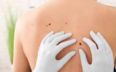 Karcinom kože – uzrok, simptomi, liječenje