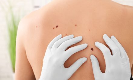 Karcinom kože – uzrok, simptomi, liječenje