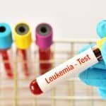 Kronična limfocitna leukemija – uzrok, simptomi, liječenje