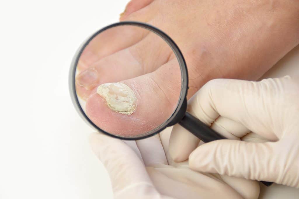 Onihomikoza noktiju - uzrok, simptomi, liječenje