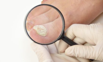 Onihomikoza noktiju – uzrok, simptomi, liječenje