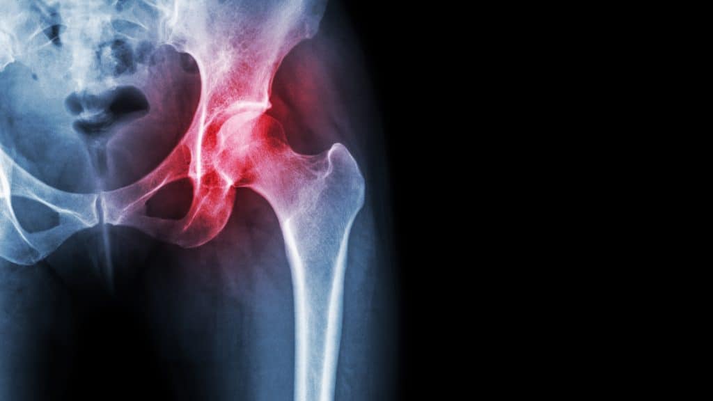 Osteoartritis kuka - uzrok, simptomi, liječenje