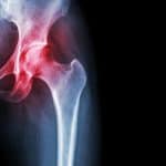 Osteoartritis kuka – uzrok, simptomi, liječenje