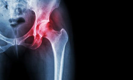 Osteoartritis kuka – uzrok, simptomi, liječenje