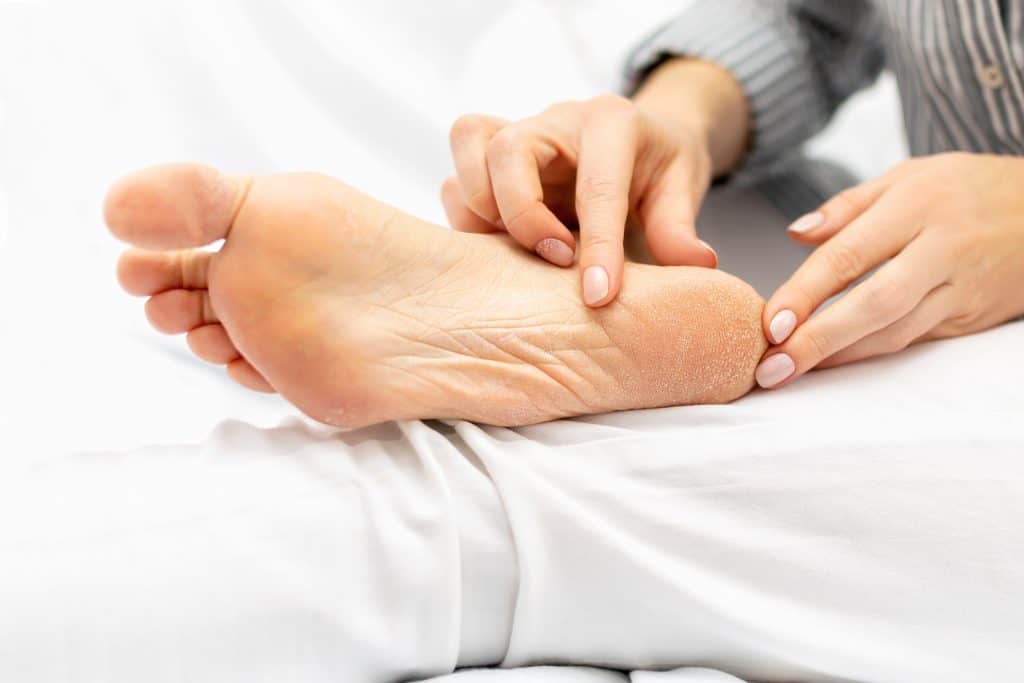 Perutanje kože na nogama - uzrok, simptomi, liječenje
