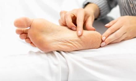 Perutanje kože na nogama – uzrok, simptomi, liječenje