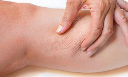 Suha koža na nogama – uzrok, simptomi, liječenje