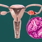 Tumori jajnika – uzrok, simptomi, liječenje