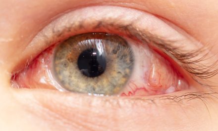 Ablacija retine (odignuće mrežnice) – uzrok, simptomi, liječenje