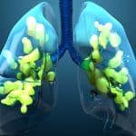 Akutni respiratorni distres sindrom – uzrok, simptomi, liječenje