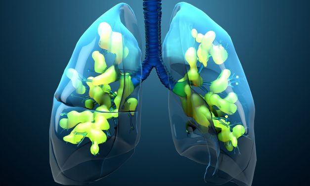 Akutni respiratorni distres sindrom – uzrok, simptomi, liječenje