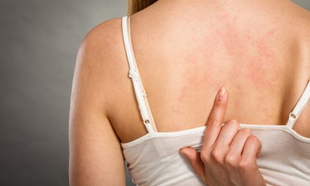 Alergijska urtikarija – uzrok, simptomi, liječenje