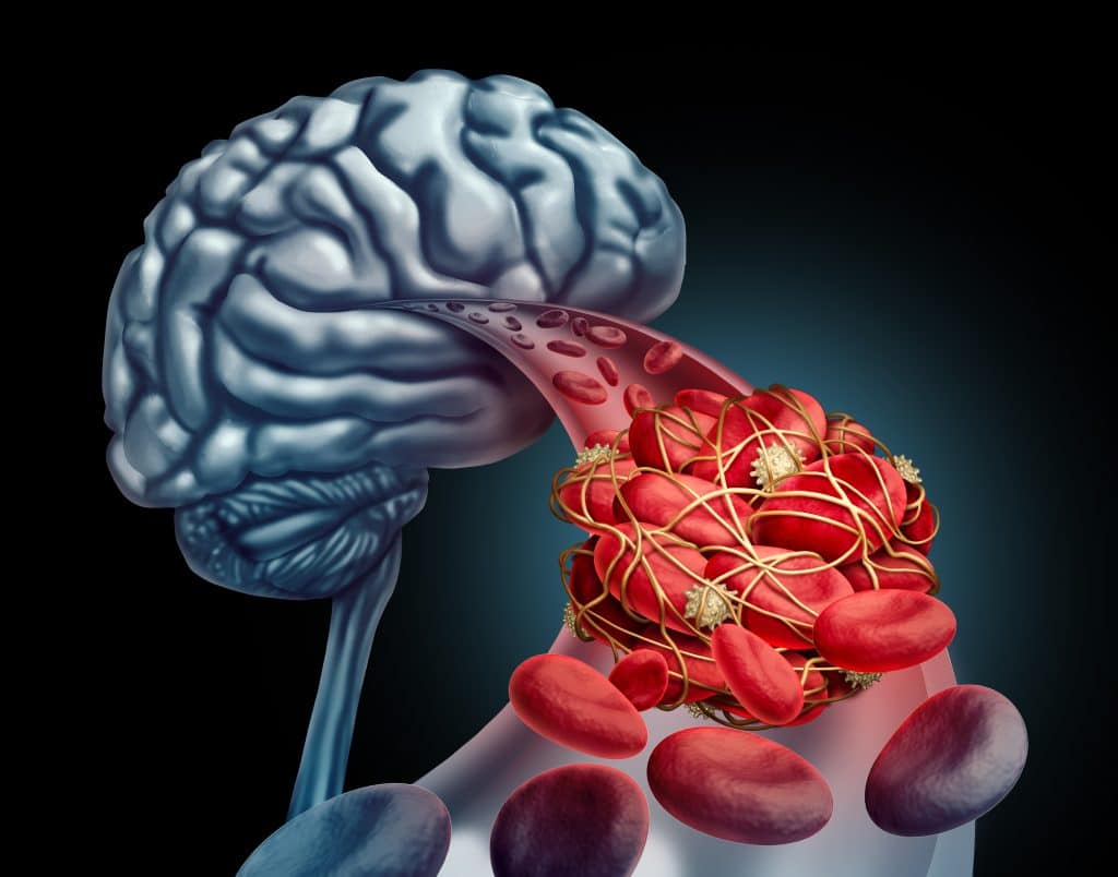 Aneurizma mozga - uzrok, simptomi, liječenje