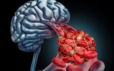 Aneurizma mozga – uzrok, simptomi, liječenje