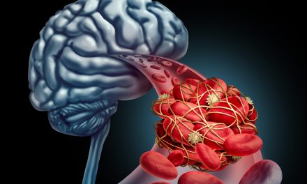 Aneurizma mozga – uzrok, simptomi, liječenje