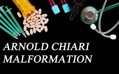 Arnold-Chiarijeva malformacija – uzrok, simptomi, liječenje
