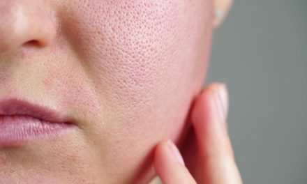 Crvenilo i ljuštenje kože na licu – uzrok, simptomi, liječenje