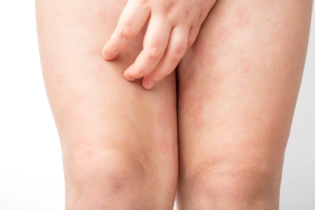 Crvenilo kože nogu - uzrok, simptomi, liječenje