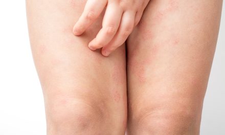 Crvenilo kože nogu – uzrok, simptomi, liječenje