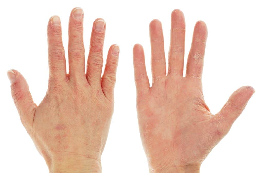 Ljuštenje kože na dlanovima - uzrok, simptomi, liječenje