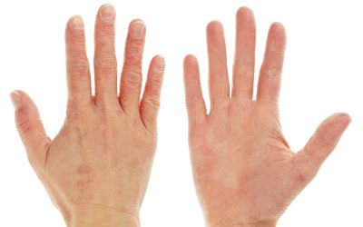 Ljuštenje kože na dlanovima – uzrok, simptomi, liječenje