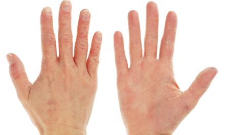 Ljuštenje kože na dlanovima – uzrok, simptomi, liječenje