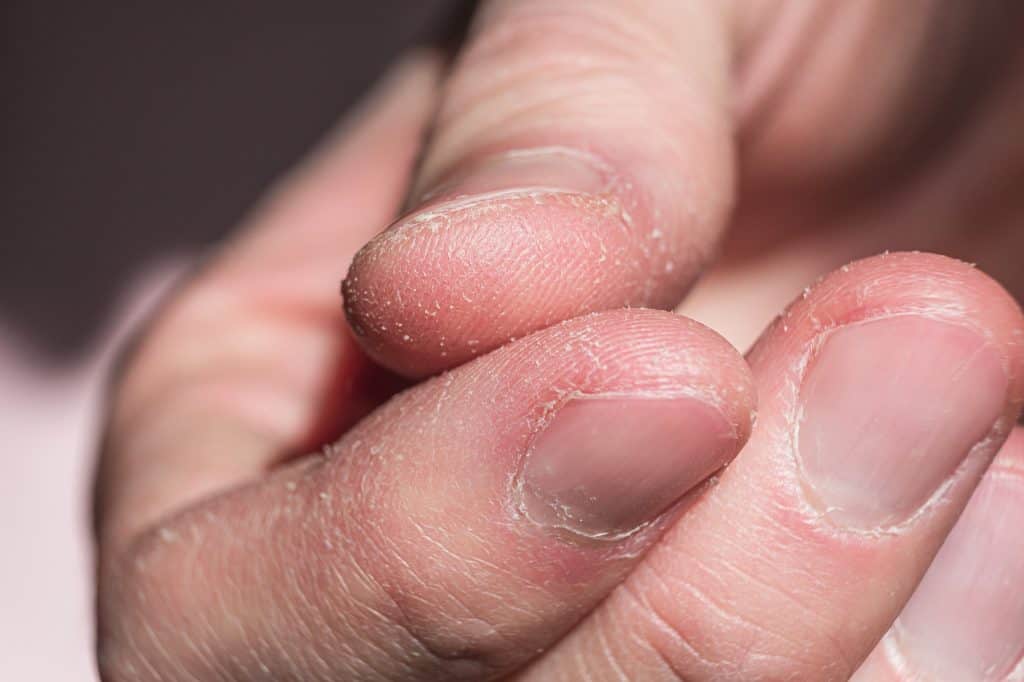 Ljuštenje kože na prstima - uzrok, simptomi, liječenje
