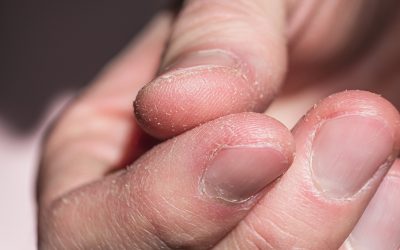 Ljuštenje kože na prstima – uzrok, simptomi, liječenje