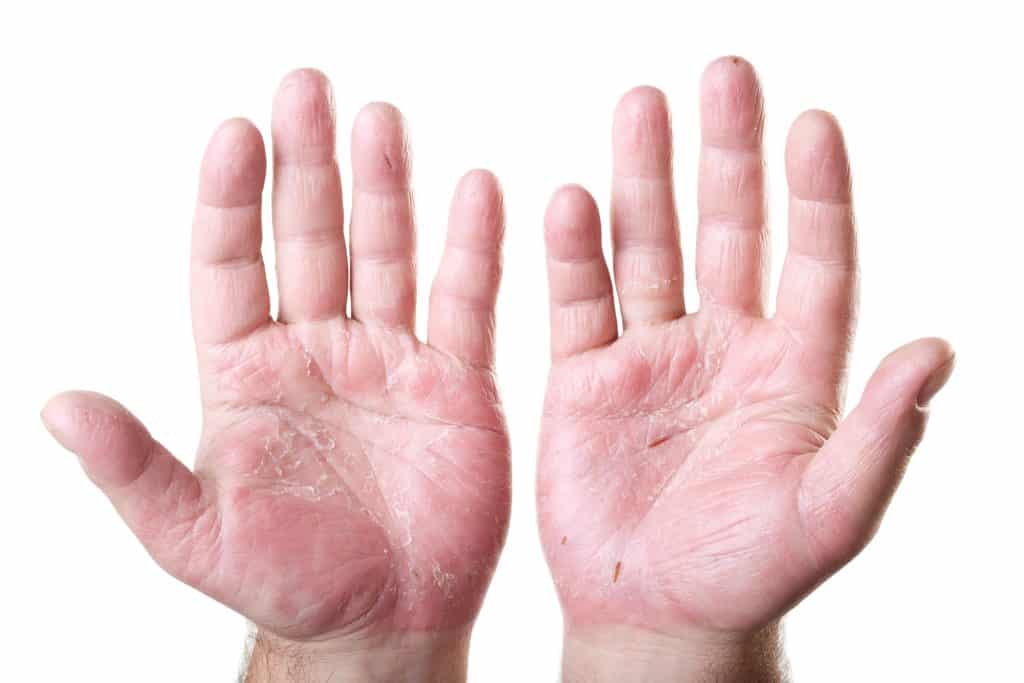 Ljuštenje kože na rukama - uzrok, simptomi, liječenje