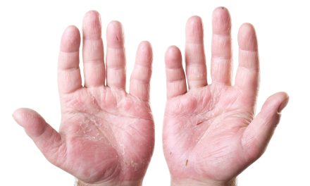 Ljuštenje kože na rukama – uzrok, simptomi, liječenje