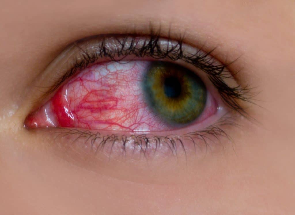 Odvajanje mrežnice oka - uzrok, simptomi, liječenje