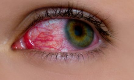 Odvajanje mrežnice oka – uzrok, simptomi, liječenje