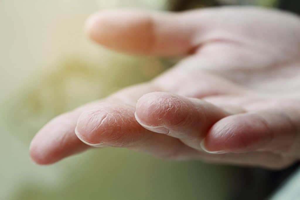 Suha koža na rukama - uzrok, simptomi, liječenje