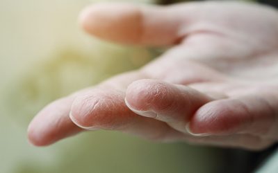 Suha koža na rukama – uzrok, simptomi, liječenje
