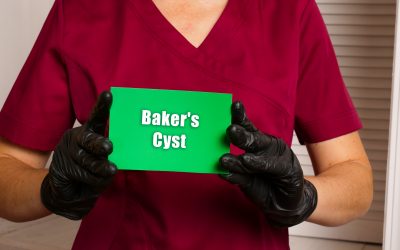 Bakerova cista – uzrok, simptomi, liječenje